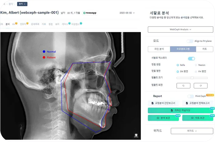 발치 여부와 변화 예측 시뮬레이션